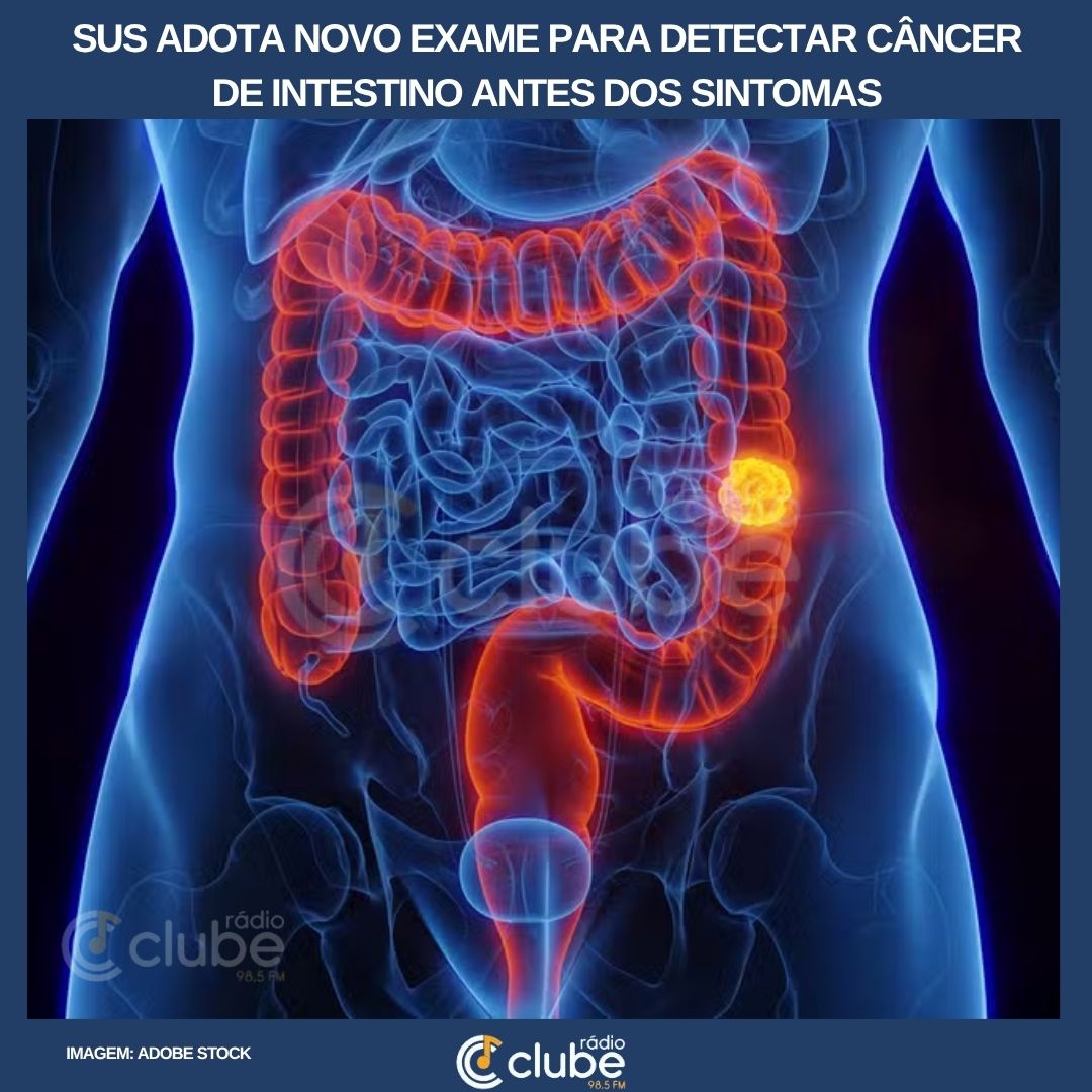 SUS adota novo exame para detectar câncer de intestino antes dos sintomas